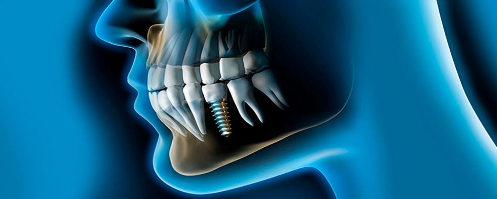 Curso Patología del Seno Maxilar relacionada con la cirugía de implantes
